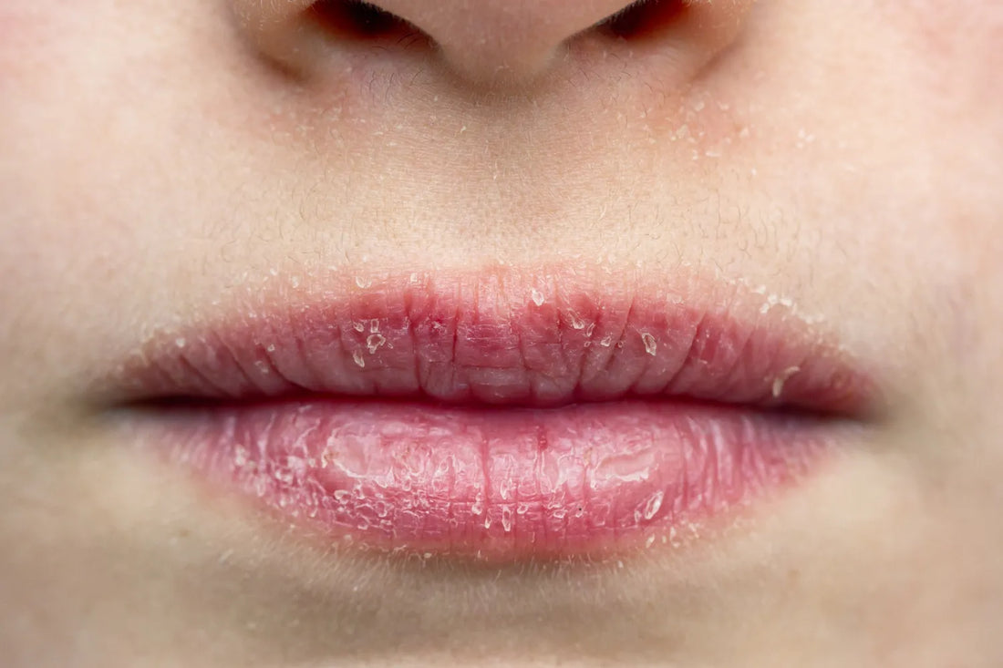 Can Dry Lips Be a Sign of Vitamin Deficiency? fatty15 Can Dry Lips Be a Sign of Vitamin Deficiency? fatty15