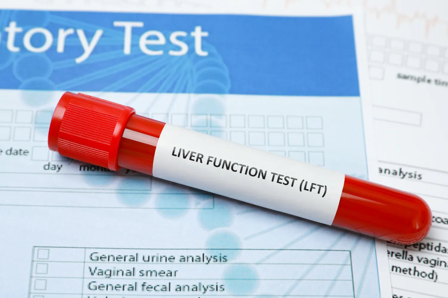 Blood sample labeled for liver function test (LFT) analysis.