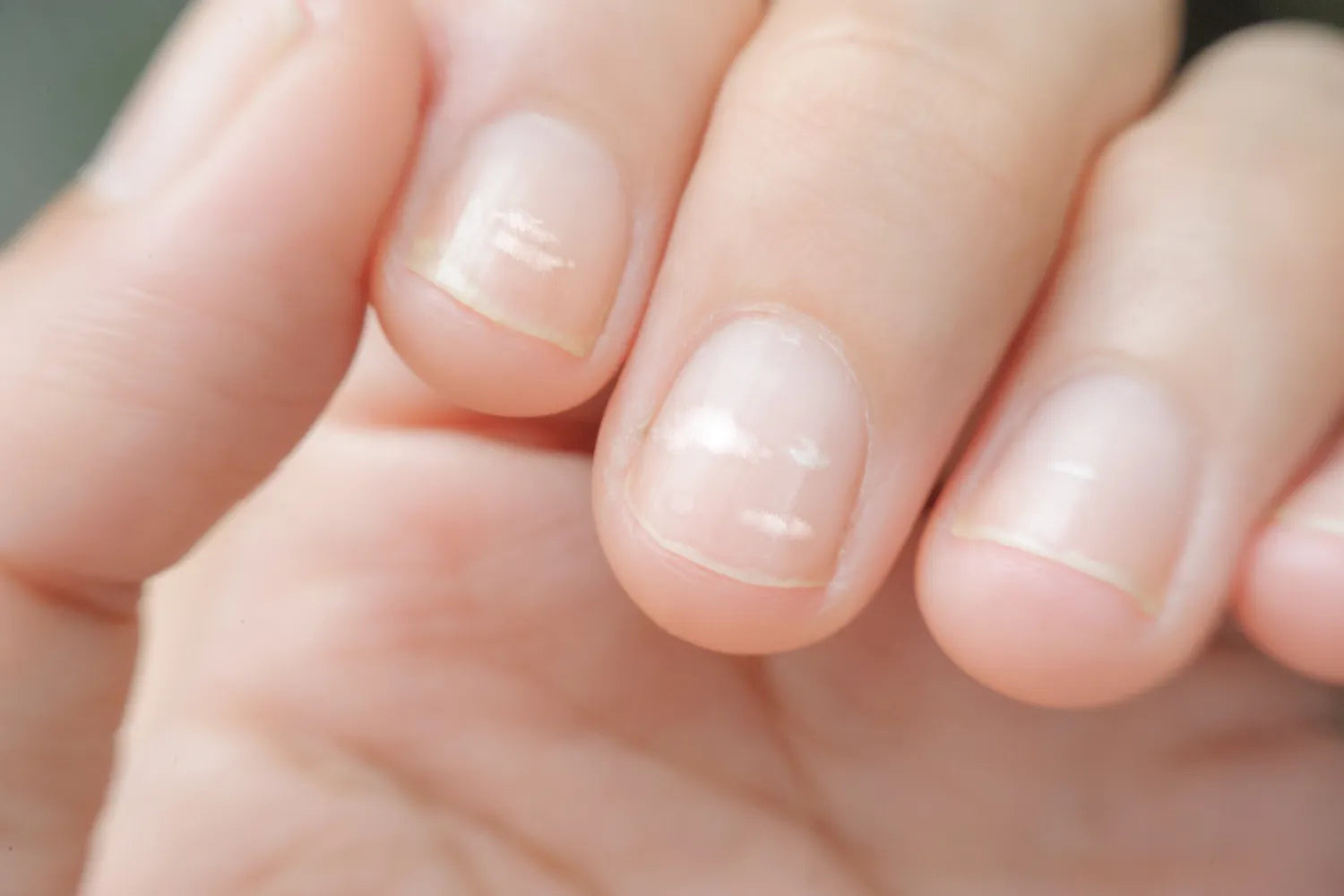 Close-up of fingernails with white spots, indicating potential nail health issues.