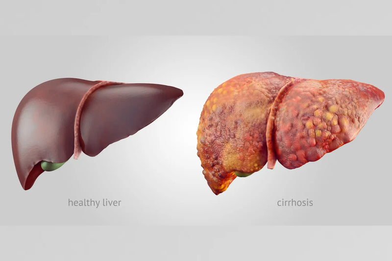 Comparison of healthy liver and liver with cirrhosis.